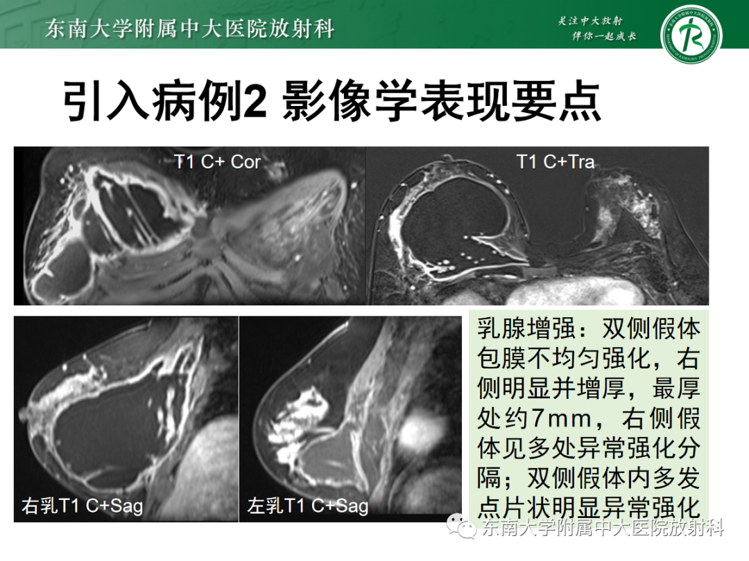 影像PPT - 【PPT】隆乳术后假体破裂的MRI表现-10