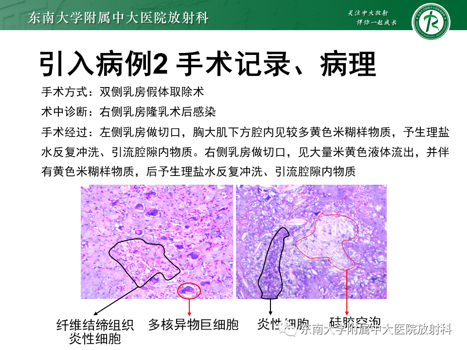 影像PPT - 【PPT】隆乳术后假体破裂的MRI表现-11
