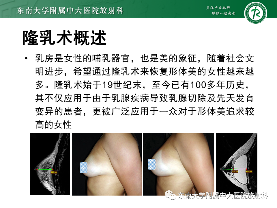 影像PPT - 【PPT】隆乳术后假体破裂的MRI表现-13