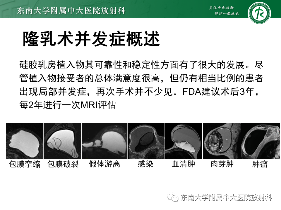 影像PPT - 【PPT】隆乳术后假体破裂的MRI表现-20