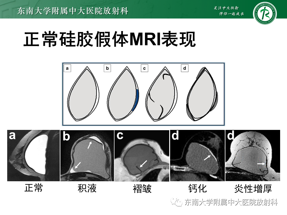 影像PPT - 【PPT】隆乳术后假体破裂的MRI表现-18