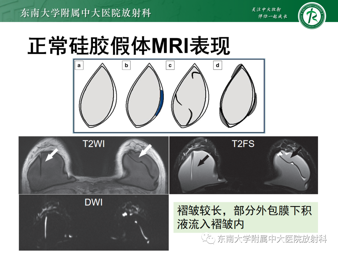 影像PPT - 【PPT】隆乳术后假体破裂的MRI表现-19