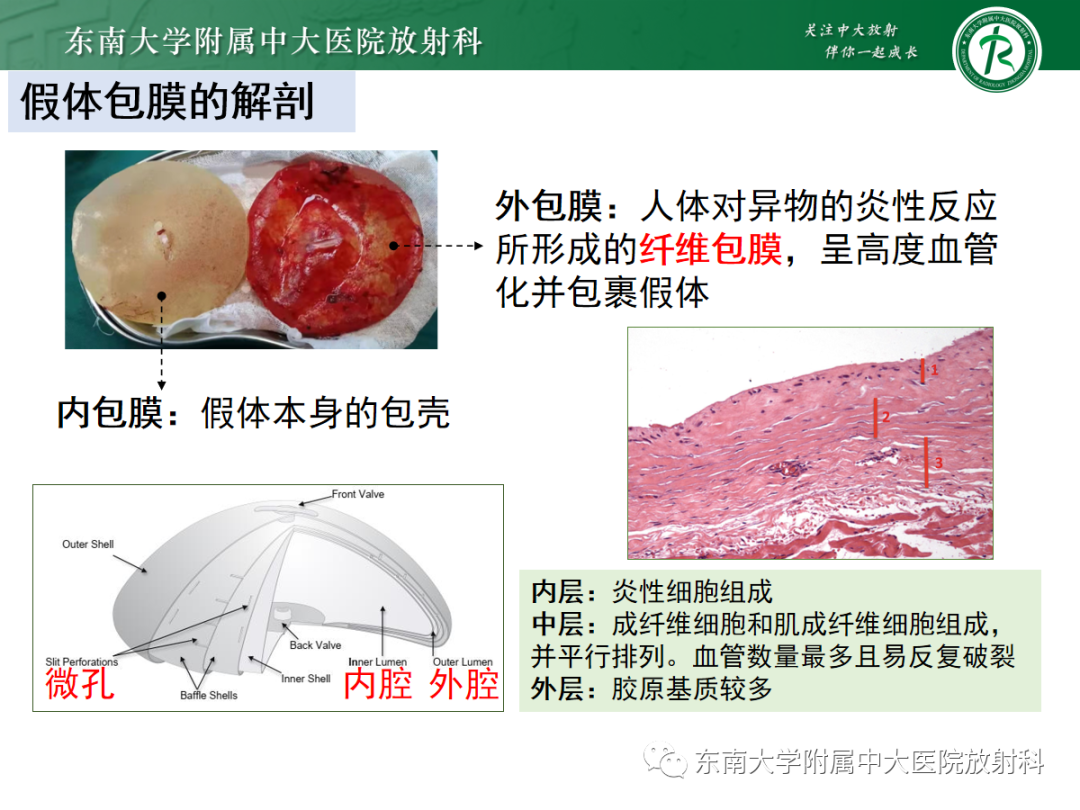 影像PPT - 【PPT】隆乳术后假体破裂的MRI表现-16