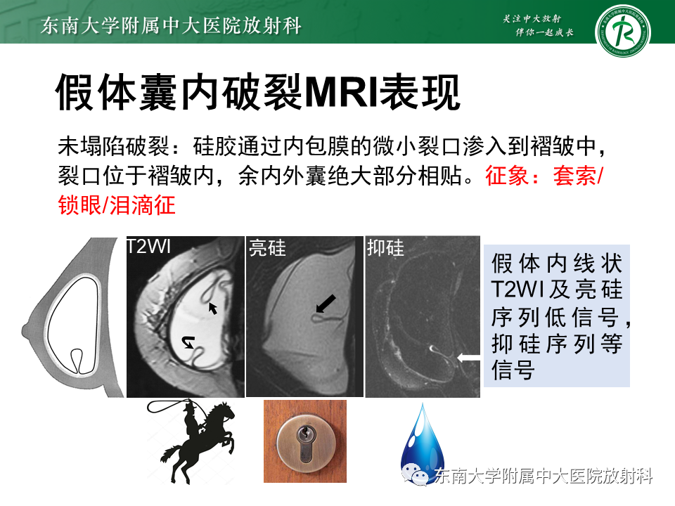 影像PPT - 【PPT】隆乳术后假体破裂的MRI表现-28