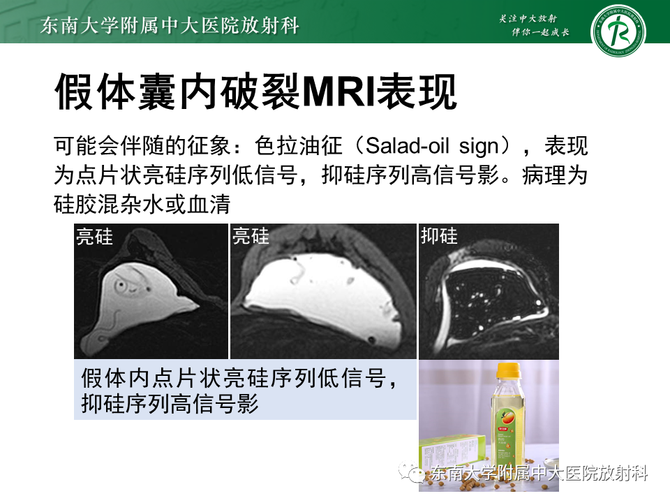 影像PPT - 【PPT】隆乳术后假体破裂的MRI表现-31