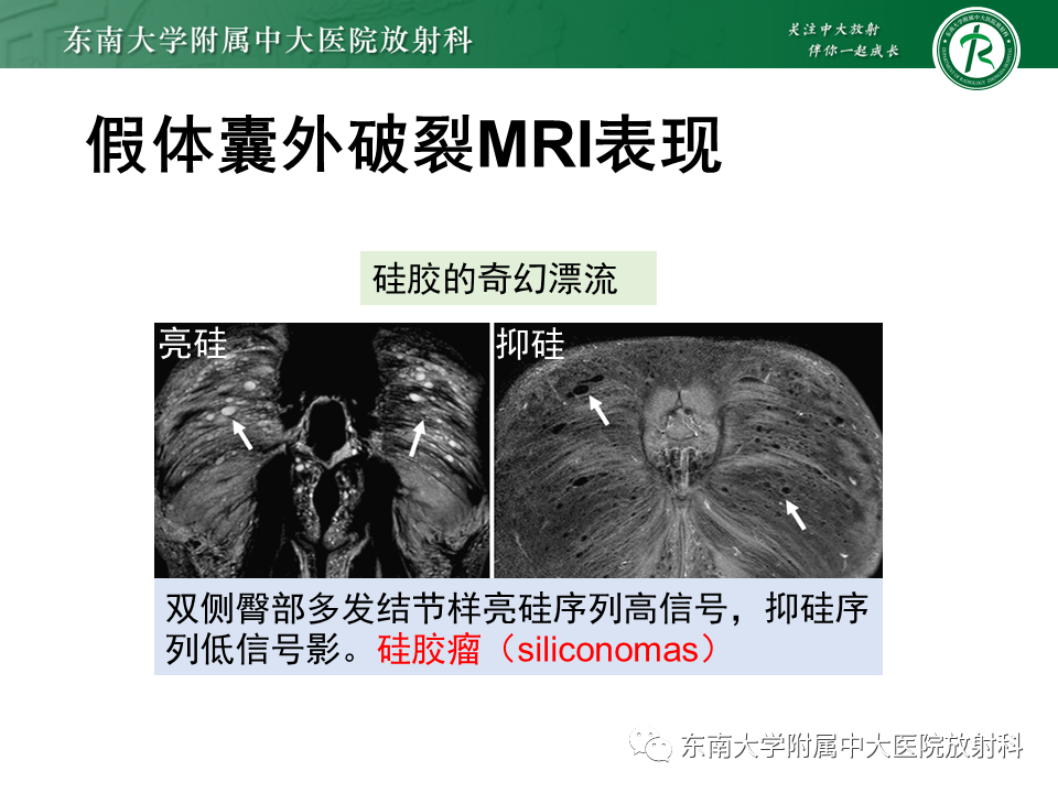 影像PPT - 【PPT】隆乳术后假体破裂的MRI表现-36