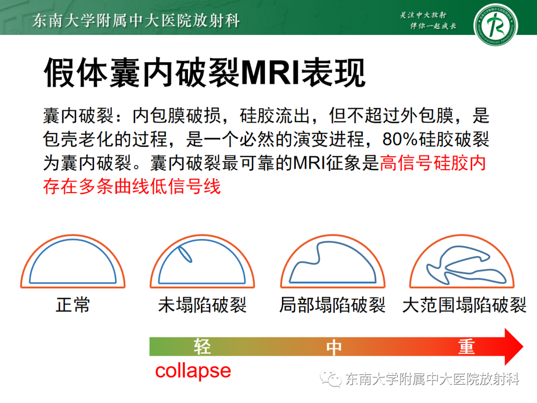 影像PPT - 【PPT】隆乳术后假体破裂的MRI表现-27