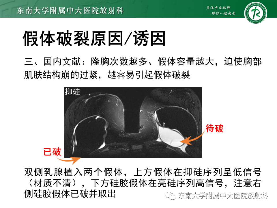 影像PPT - 【PPT】隆乳术后假体破裂的MRI表现-24