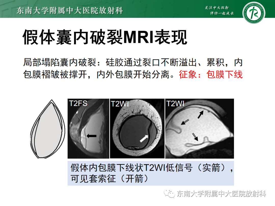 影像PPT - 【PPT】隆乳术后假体破裂的MRI表现-29