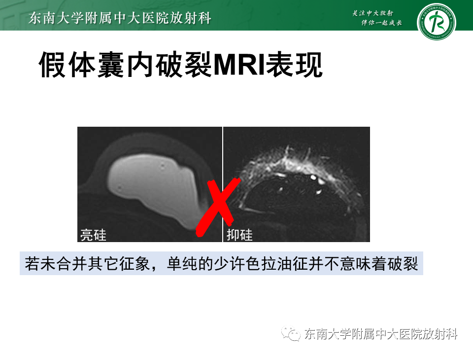 影像PPT - 【PPT】隆乳术后假体破裂的MRI表现-32