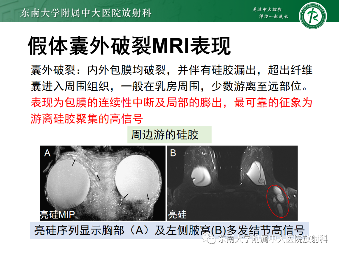 影像PPT - 【PPT】隆乳术后假体破裂的MRI表现-34
