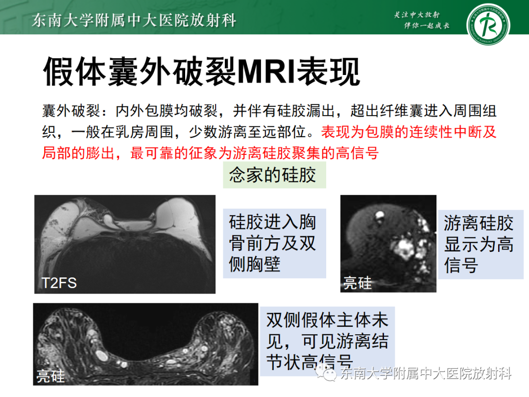 影像PPT - 【PPT】隆乳术后假体破裂的MRI表现-33