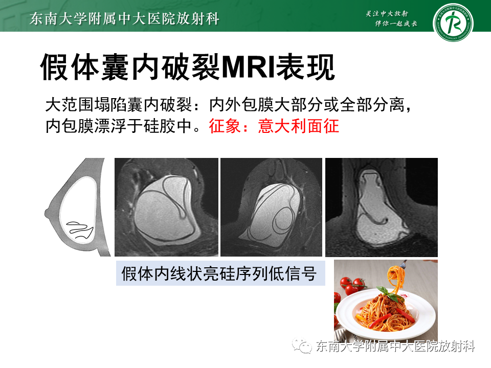 影像PPT - 【PPT】隆乳术后假体破裂的MRI表现-30