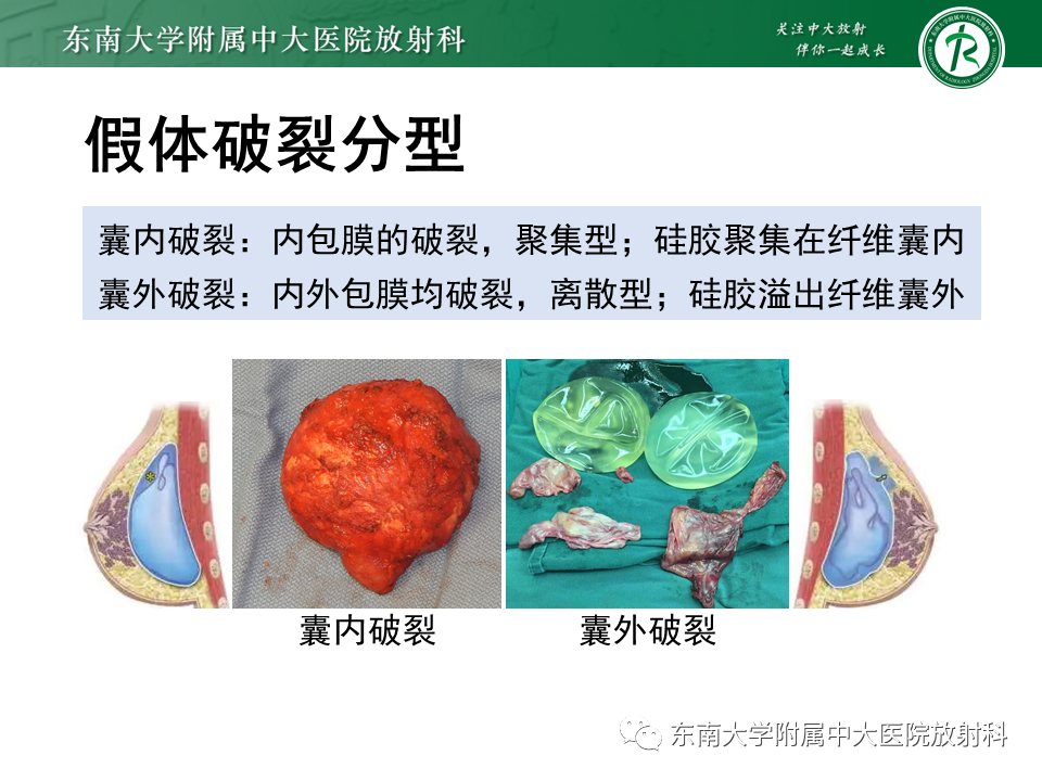 影像PPT - 【PPT】隆乳术后假体破裂的MRI表现-26
