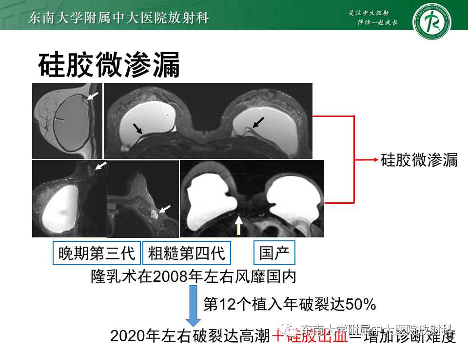影像PPT - 【PPT】隆乳术后假体破裂的MRI表现-41