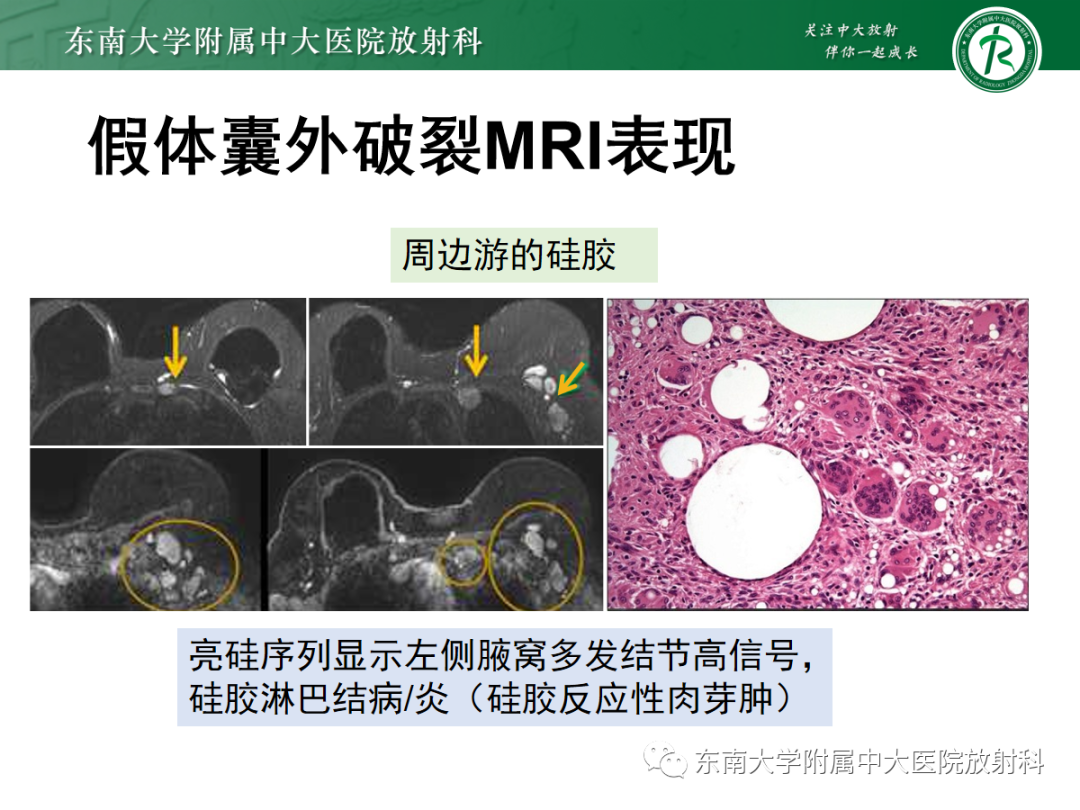 影像PPT - 【PPT】隆乳术后假体破裂的MRI表现-35