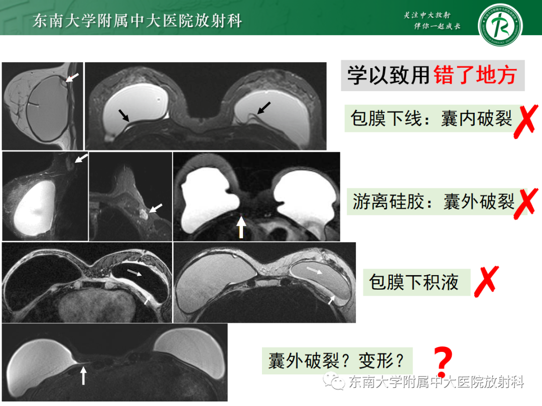 影像PPT - 【PPT】隆乳术后假体破裂的MRI表现-37