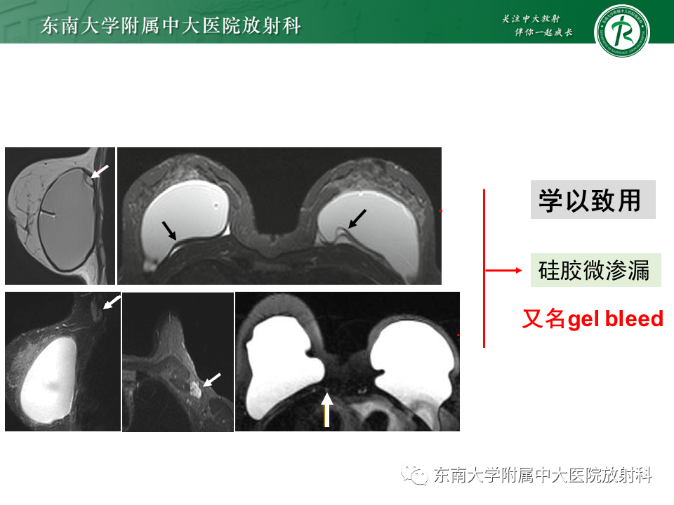 影像PPT - 【PPT】隆乳术后假体破裂的MRI表现-38