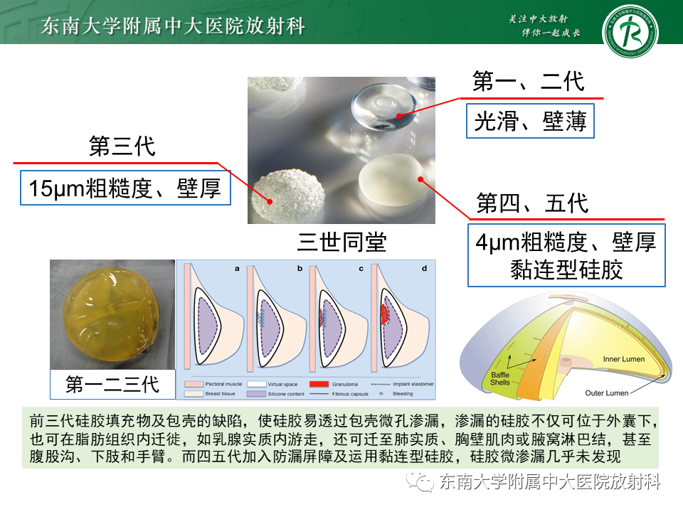 影像PPT - 【PPT】隆乳术后假体破裂的MRI表现-39