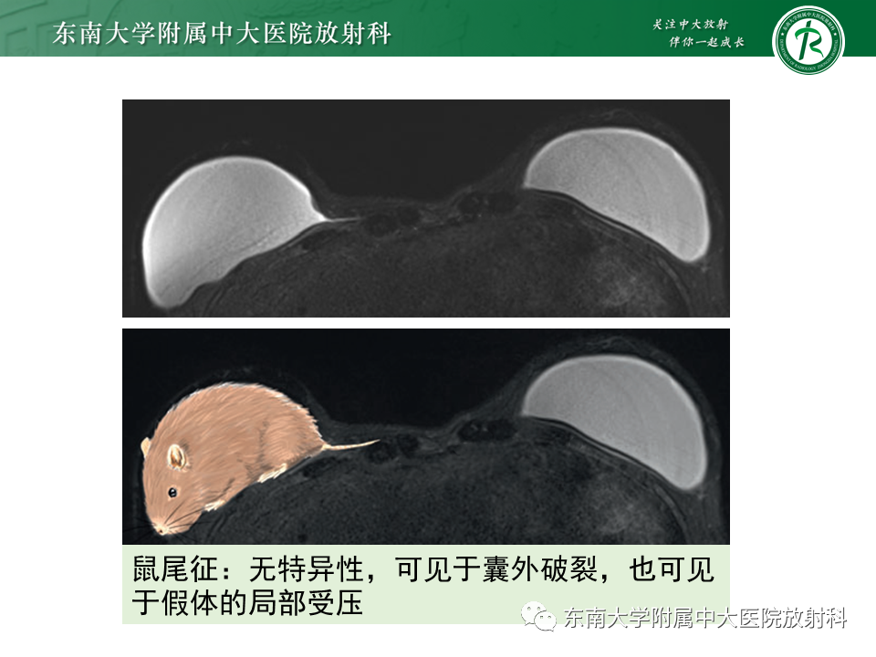影像PPT - 【PPT】隆乳术后假体破裂的MRI表现-43
