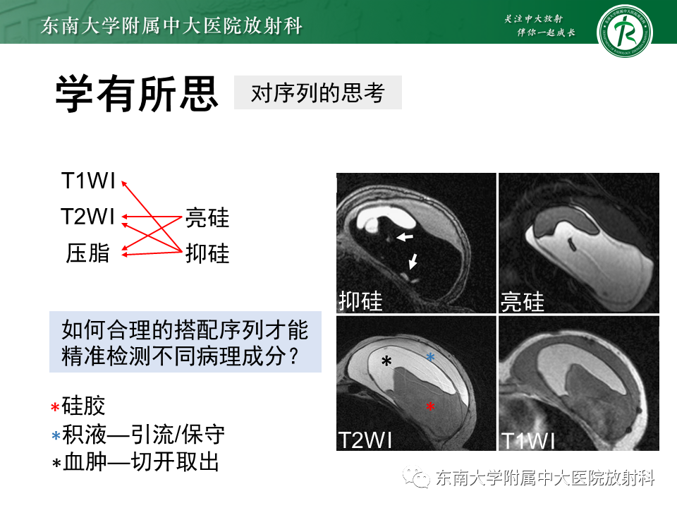 影像PPT - 【PPT】隆乳术后假体破裂的MRI表现-47