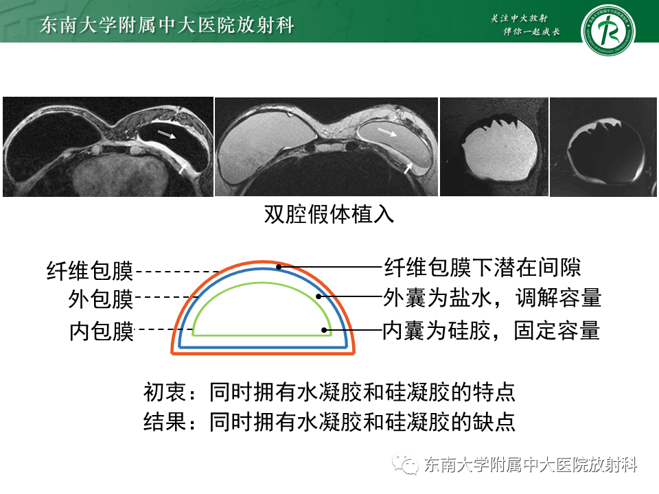 影像PPT - 【PPT】隆乳术后假体破裂的MRI表现-42