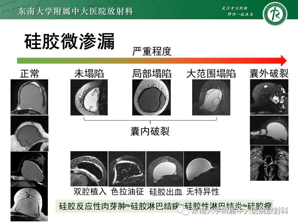 影像PPT - 【PPT】隆乳术后假体破裂的MRI表现-45