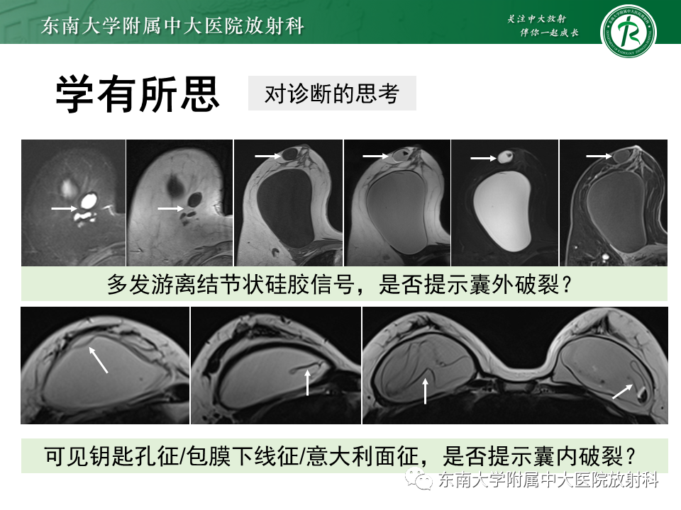 影像PPT - 【PPT】隆乳术后假体破裂的MRI表现-48