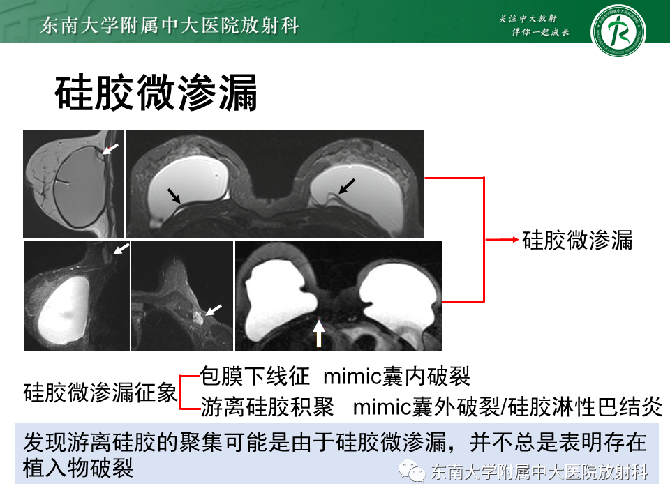 影像PPT - 【PPT】隆乳术后假体破裂的MRI表现-40