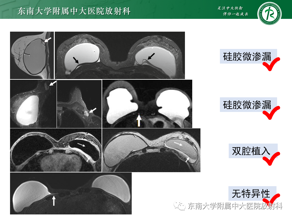 影像PPT - 【PPT】隆乳术后假体破裂的MRI表现-44