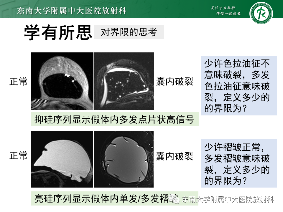 影像PPT - 【PPT】隆乳术后假体破裂的MRI表现-46
