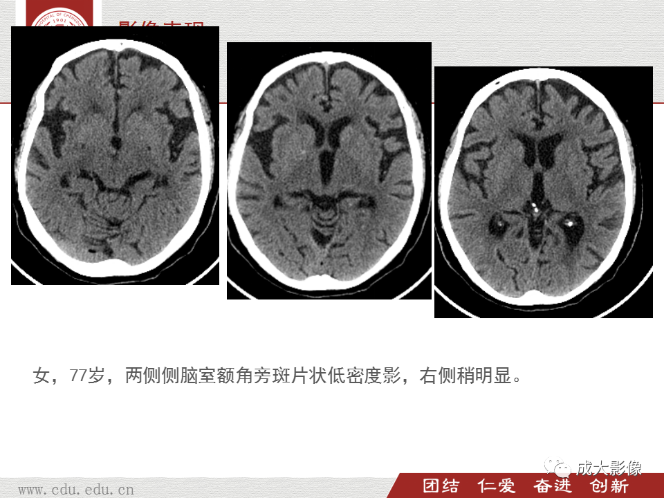 影像PPT - 【PPT】脑白质疏松症-9