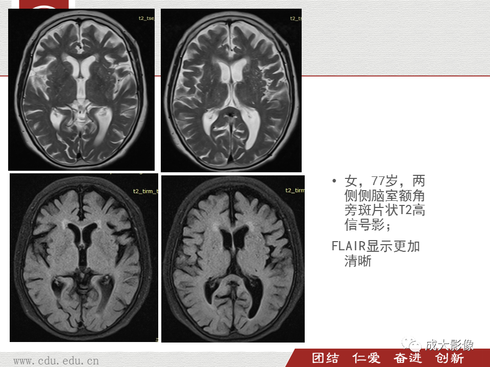 影像PPT - 【PPT】脑白质疏松症-12