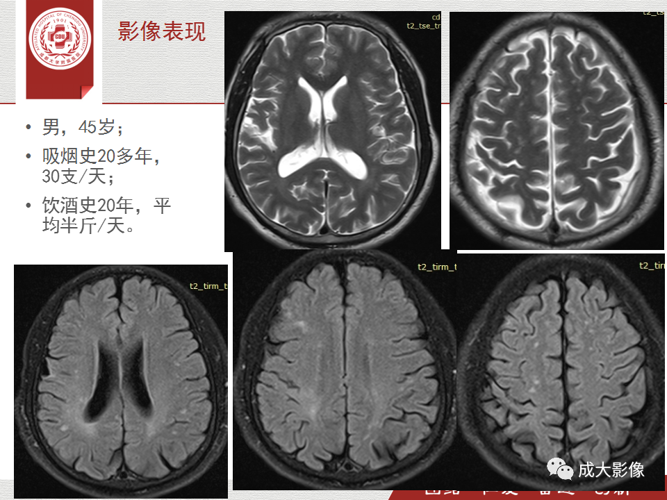 影像PPT - 【PPT】脑白质疏松症-13