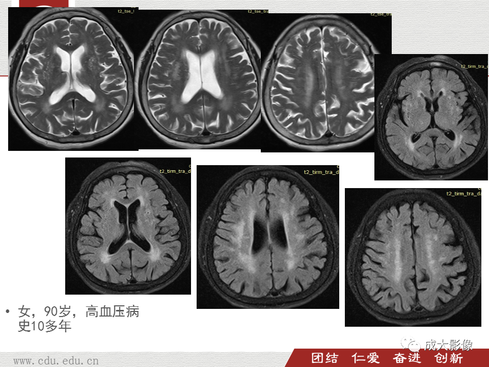 影像PPT - 【PPT】脑白质疏松症-14
