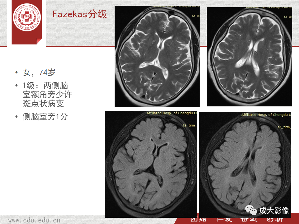 影像PPT - 【PPT】脑白质疏松症-19