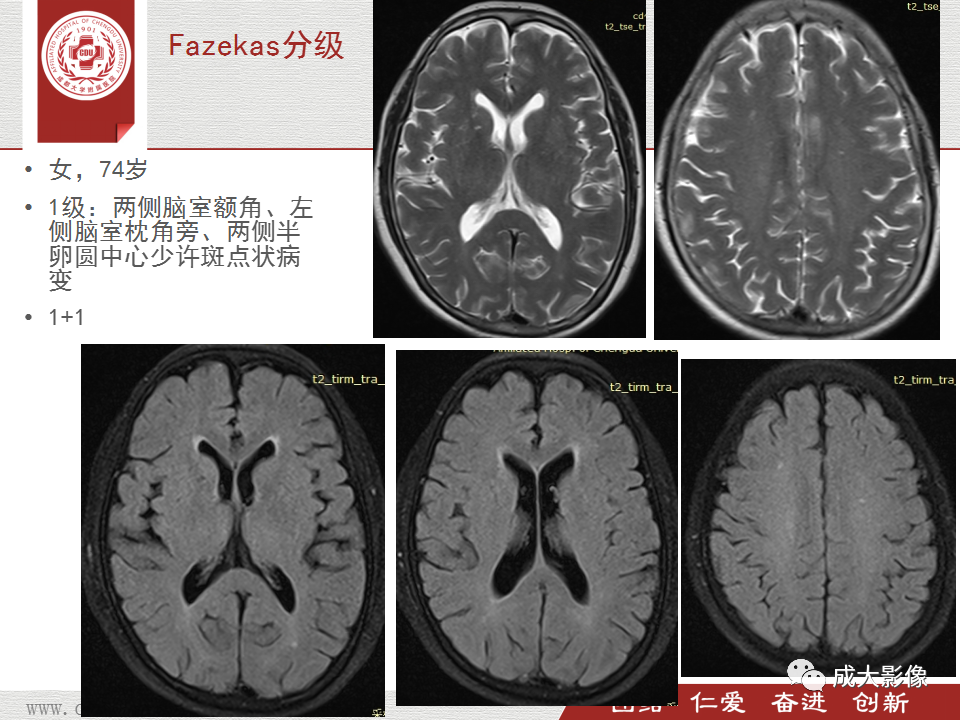 影像PPT - 【PPT】脑白质疏松症-20