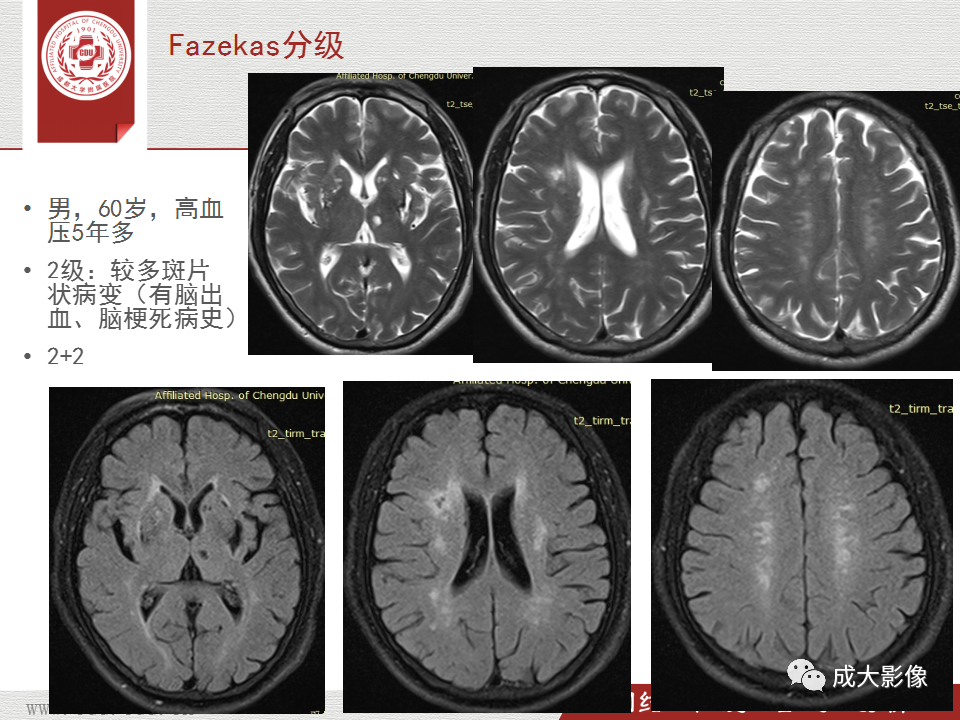 影像PPT - 【PPT】脑白质疏松症-21