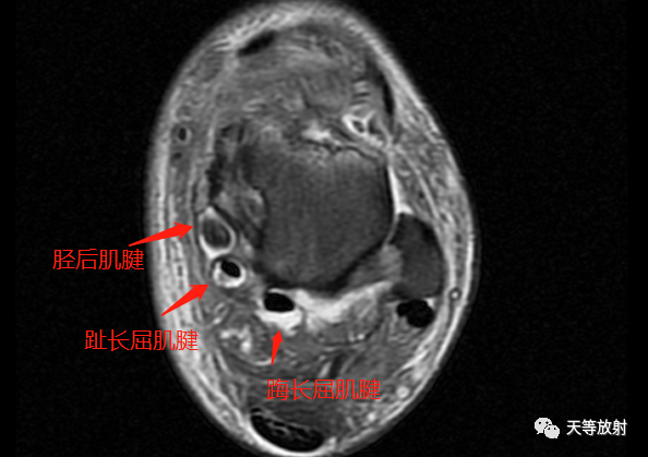 影像PPT - 糖尿病足-3 影像PPT - 糖尿病足-3