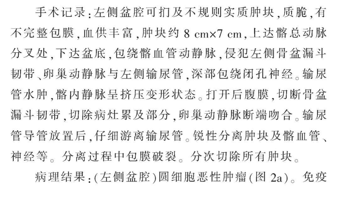 影像PPT - 【病例】盆腔腹膜外肿块—淋巴瘤1例影像诊断思维-5