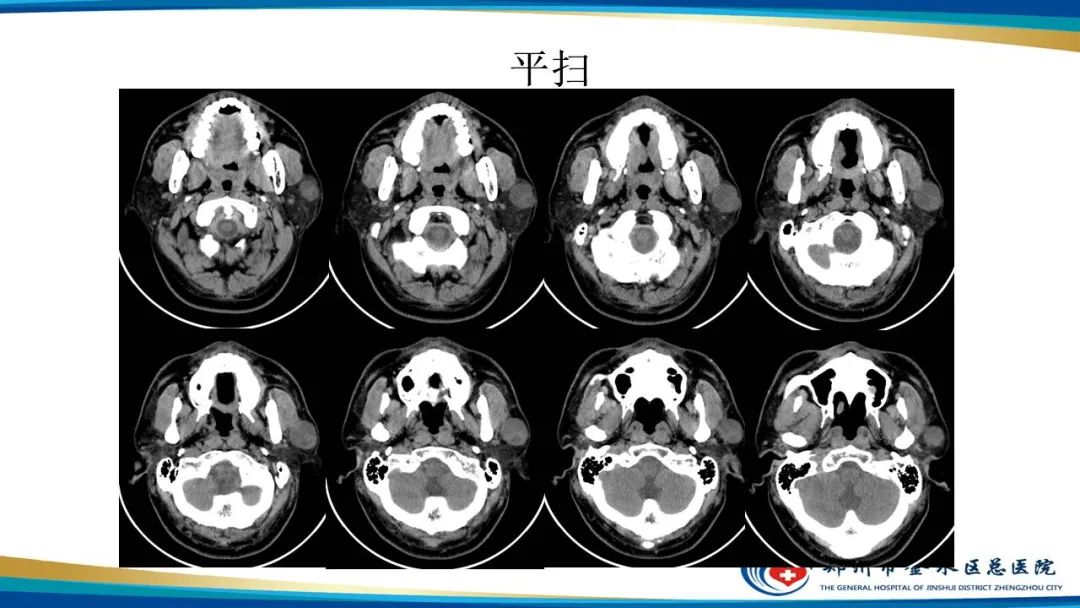 影像PPT - 【病例】腮腺多形性腺瘤1例CT影像-4