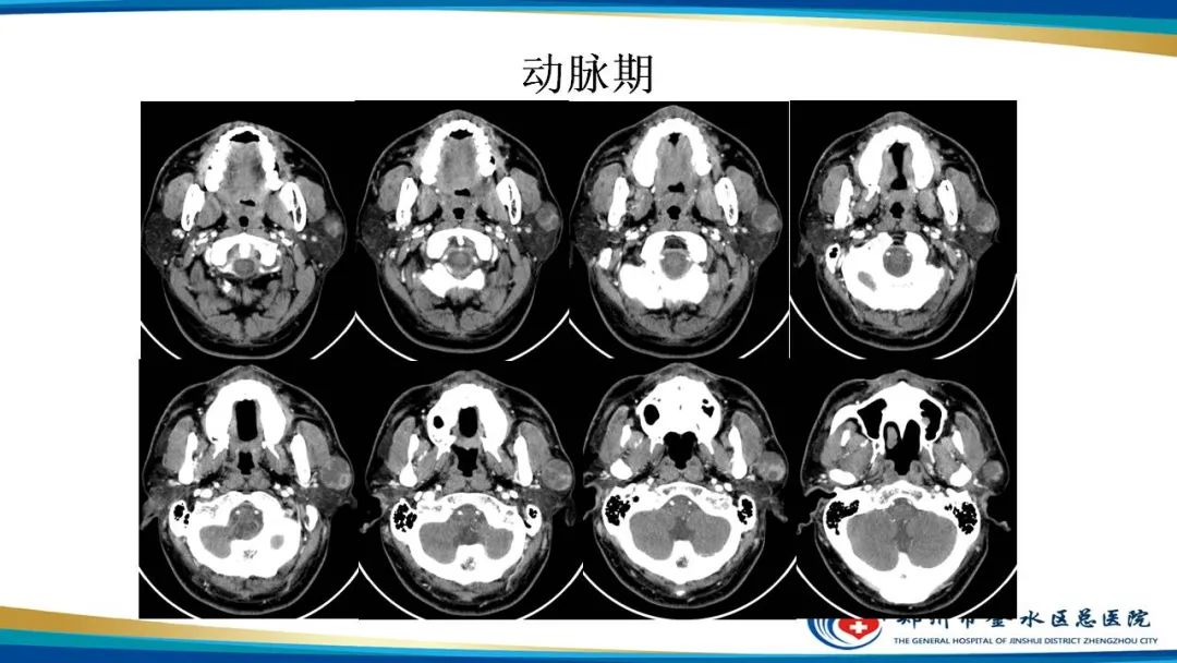 影像PPT - 【病例】腮腺多形性腺瘤1例CT影像-5