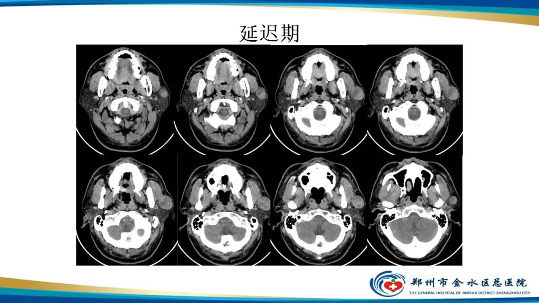 影像PPT - 【病例】腮腺多形性腺瘤1例CT影像-7