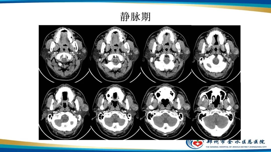 影像PPT - 【病例】腮腺多形性腺瘤1例CT影像-6