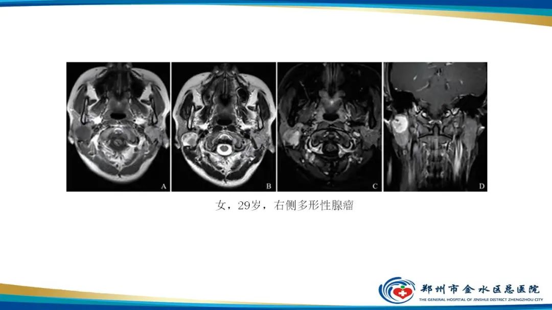 影像PPT - 【病例】腮腺多形性腺瘤1例CT影像-21