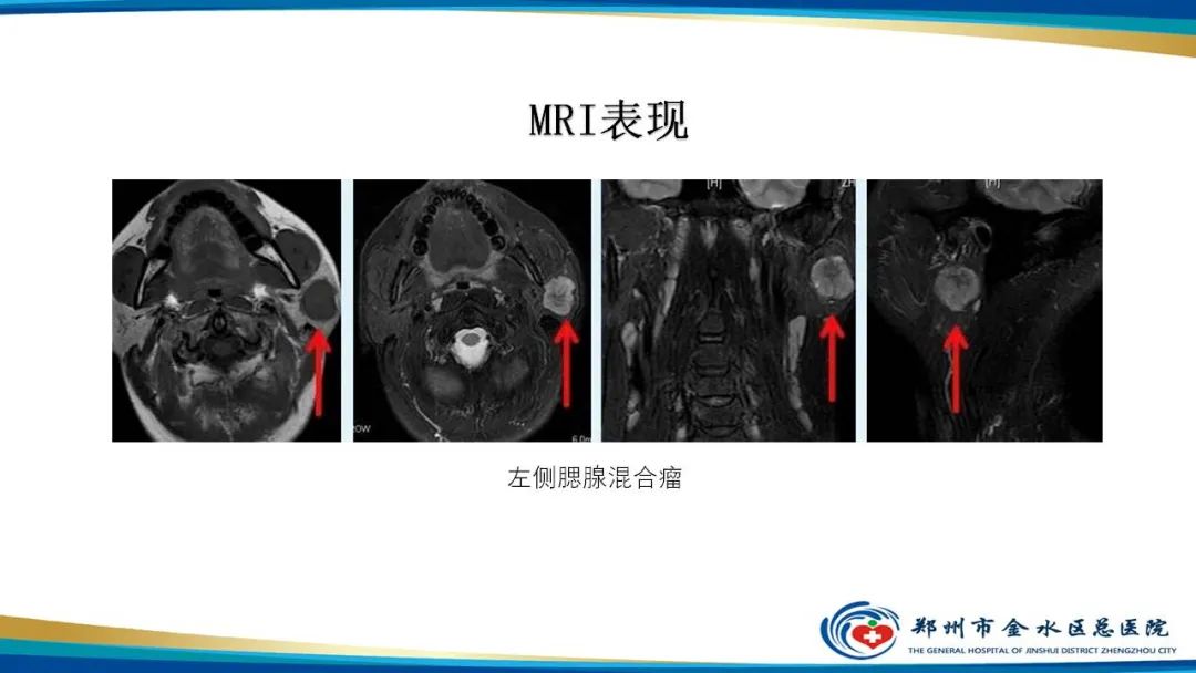 影像PPT - 【病例】腮腺多形性腺瘤1例CT影像-23