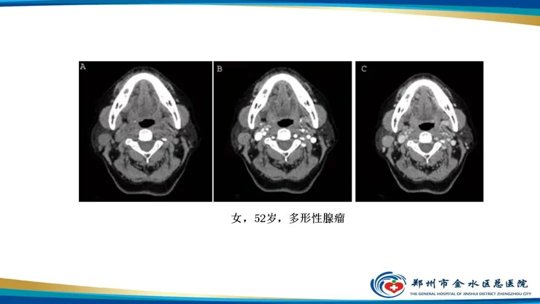 影像PPT - 【病例】腮腺多形性腺瘤1例CT影像-18