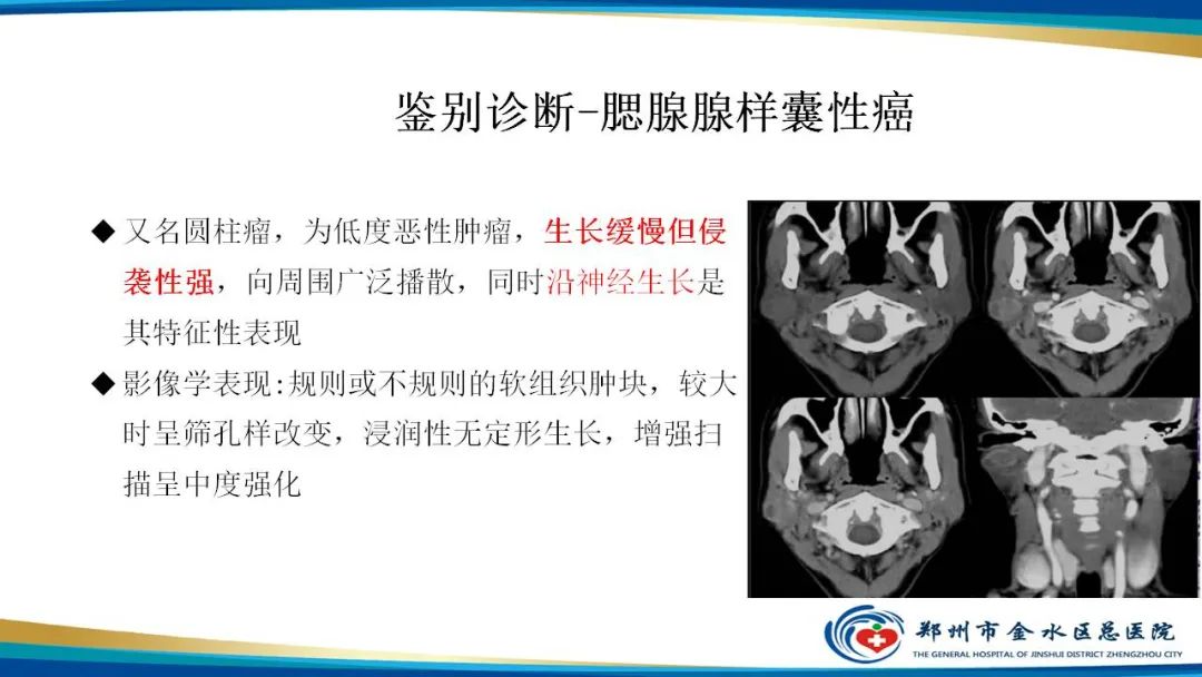 影像PPT - 【病例】腮腺多形性腺瘤1例CT影像-28