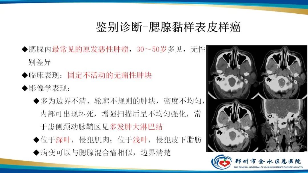 影像PPT - 【病例】腮腺多形性腺瘤1例CT影像-27