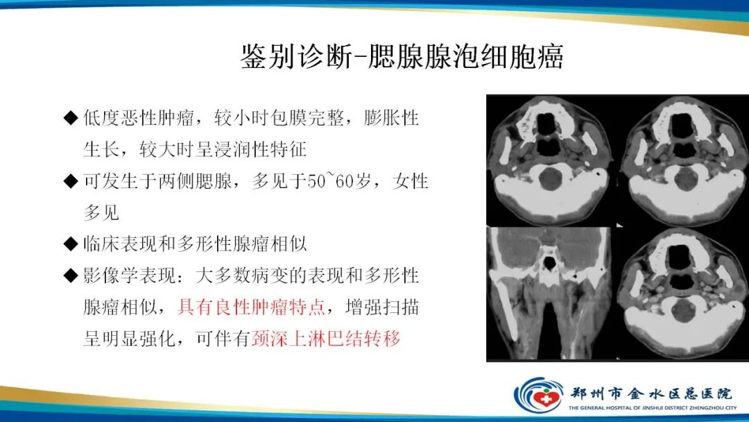 影像PPT - 【病例】腮腺多形性腺瘤1例CT影像-29